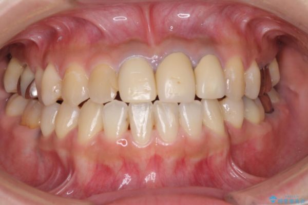 ホワイトニングで白くなった歯の色に合わせて補綴を入れたい 治療前画像