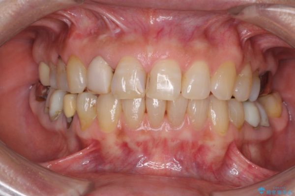 長年気にしていた前歯の変色をセラミックで自然な白さに 治療前画像