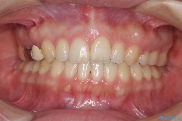 前歯の出っ歯を抜歯矯正で改善　整った歯並びに 治療後画像