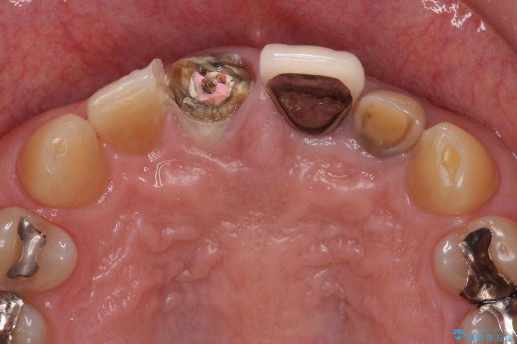 前歯の被せものがとれた　メタルボンドからオールセラミッククラウンへ 治療前