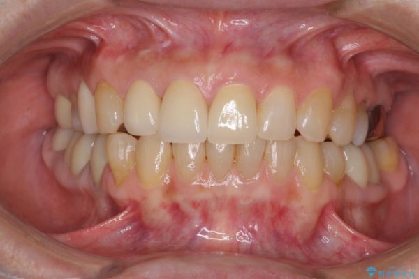 長年気にしていた前歯の変色をセラミックで自然な白さに 治療後画像