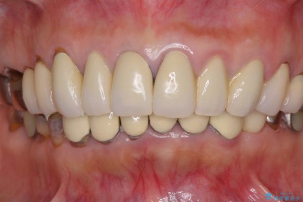 金属の色が見えてしまった前歯をオールセラミックに 治療前画像