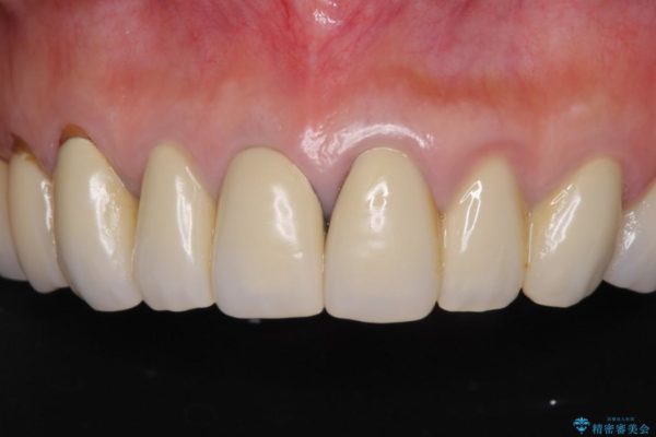 金属の色が見えてしまった前歯をオールセラミックに 治療前画像