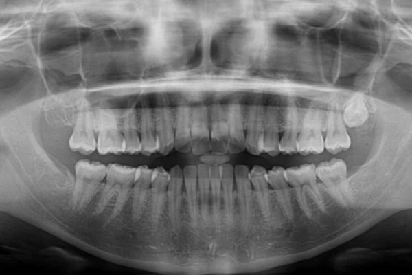 インビザラインで前歯のでこぼこを改善 治療後画像