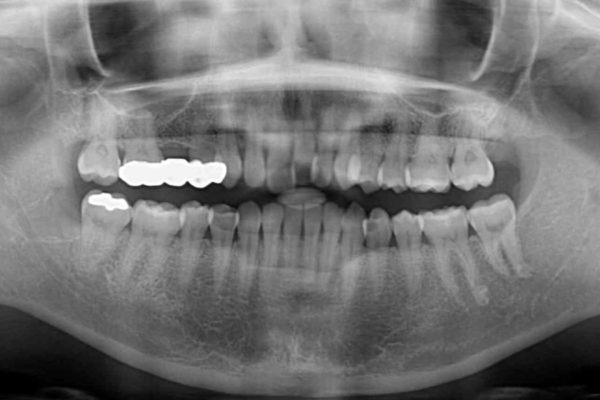 前歯の出っ歯を抜歯矯正で改善　整った歯並びに 治療前画像