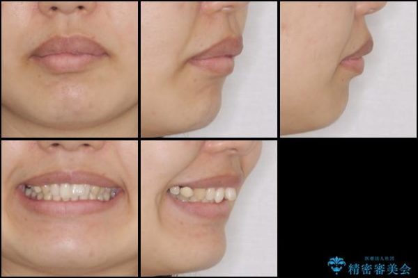 前歯の出っ歯を抜歯矯正で改善　整った歯並びに 治療前画像