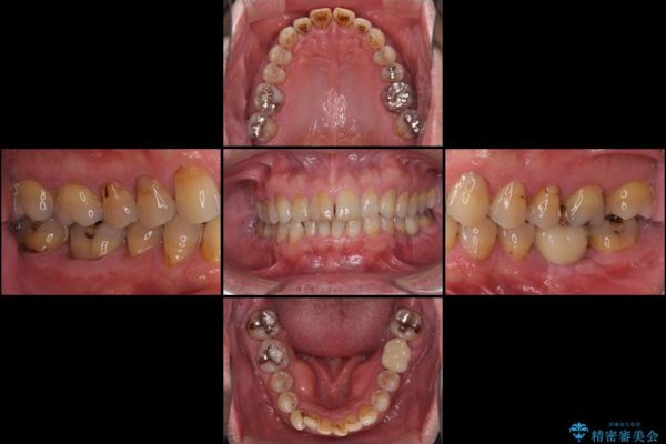 奥歯が割れてしまった　ストローマンインプラントによる咬合回復 治療後画像