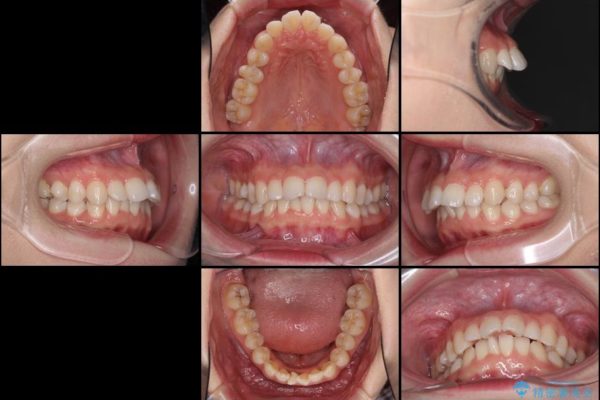 気になる上の出っ歯をインビザラインによる非抜歯矯正で治療 治療前画像