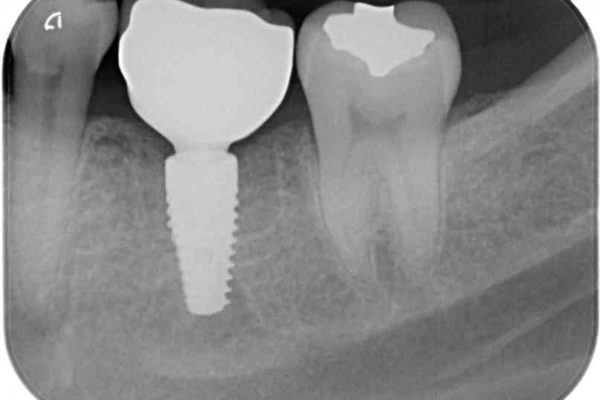 奥歯が割れてしまった　ストローマンインプラントによる咬合回復 治療後画像