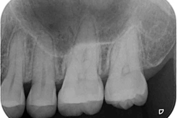 正面から見えてしまう銀歯 セラミックインレーで改善 治療後画像