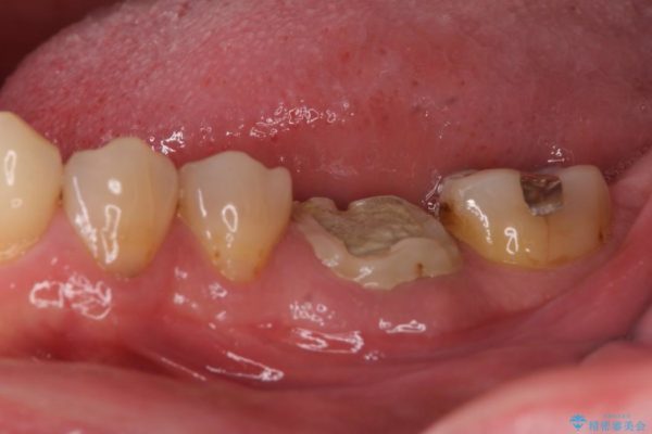 奥歯が割れてしまった　ストローマンインプラントによる咬合回復 治療前画像