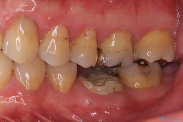 奥歯が割れてしまった　ストローマンインプラントによる咬合回復 治療前画像