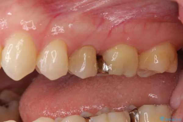 正面から見えてしまう銀歯 セラミックインレーで改善 治療前画像