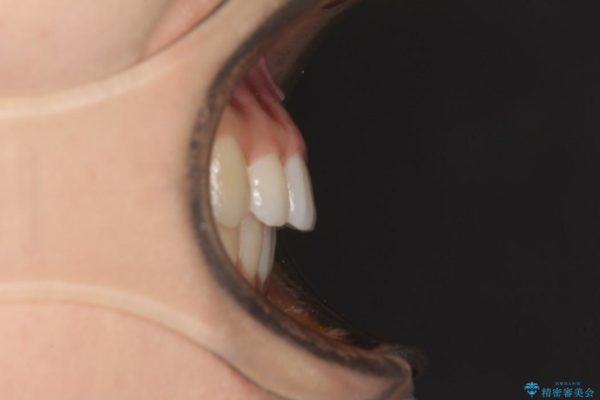 気になる上の出っ歯をインビザラインによる非抜歯矯正で治療 治療後画像