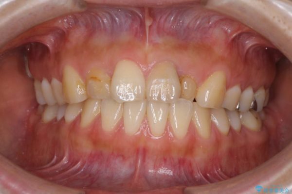 前歯のデコボコと変色を改善　インビザラインとオールセラミックによる治療 治療前画像