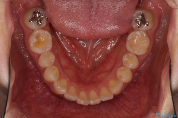 前歯のデコボコと変色を改善　インビザラインとオールセラミックによる治療 治療前画像