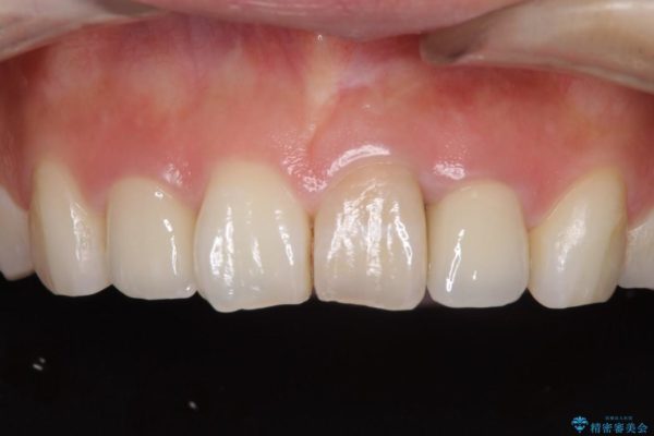 前歯のデコボコと変色を改善　インビザラインとオールセラミックによる治療 治療後画像