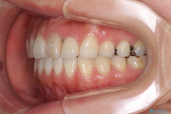 前歯のデコボコと変色を改善　インビザラインとオールセラミックによる治療 治療後画像