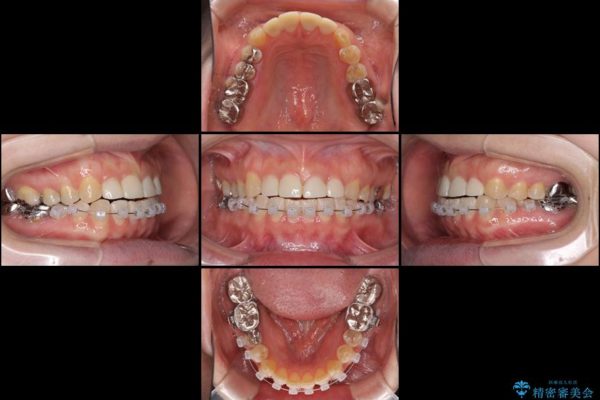 隙間の空いた前歯を治したい　部分矯正とオールセラミッククラウン 治療後画像