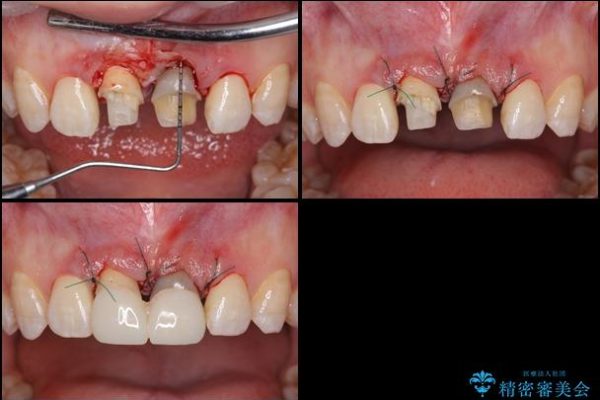 短い前歯を長くしたい 外科処置を用いた前歯のセラミック治療 治療後画像
