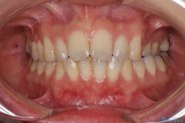 妊娠中でも綺麗な歯並びに インビザラインによる矯正治療 治療前画像