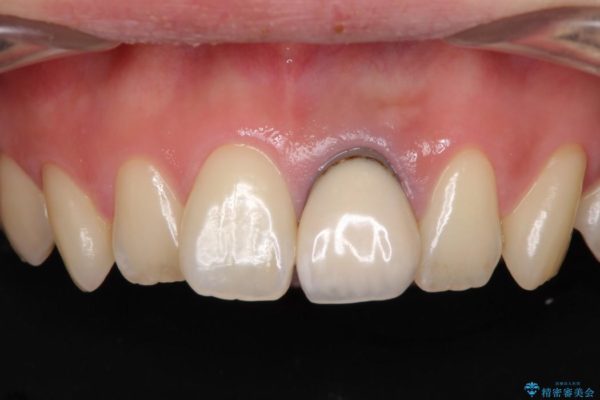 歯肉のラインが汚れている前歯　根管治療とセラミックによる審美治療 ビフォー
