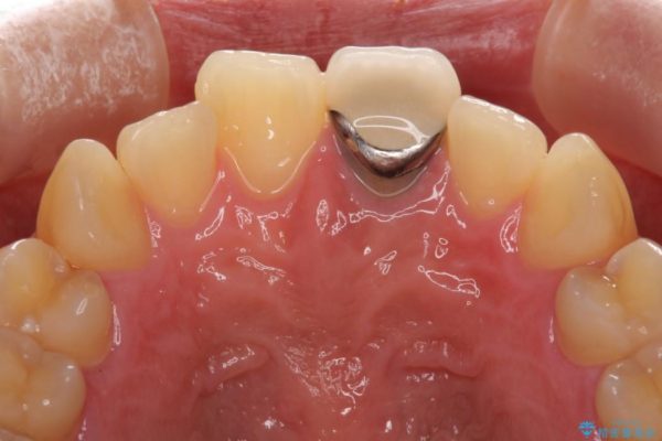歯肉のラインが汚れている前歯　根管治療とセラミックによる審美治療 治療前画像