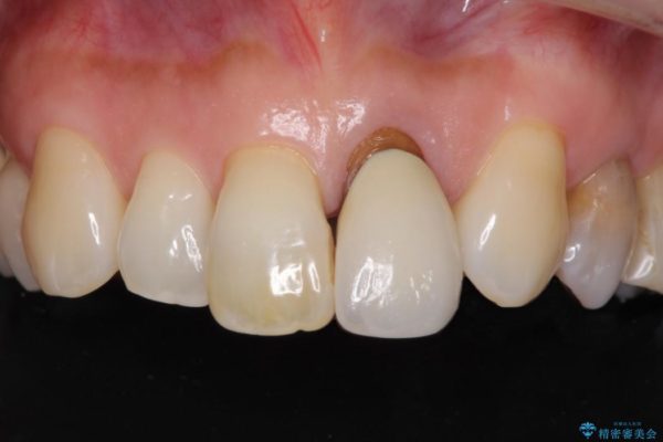 前歯のクラウンの茶色い縁を綺麗にしたい オールセラミックによる治療 治療前画像