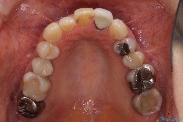 前歯のクラウンの茶色い縁を綺麗にしたい オールセラミックによる治療 治療前画像