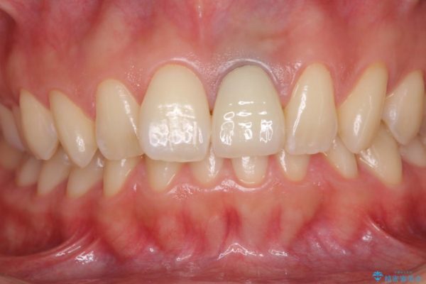 歯肉のラインが汚れている前歯　根管治療とセラミックによる審美治療 治療後画像