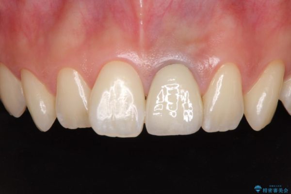 歯肉のラインが汚れている前歯　根管治療とセラミックによる審美治療 アフター