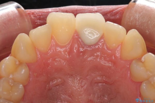 歯肉のラインが汚れている前歯　根管治療とセラミックによる審美治療 治療後画像