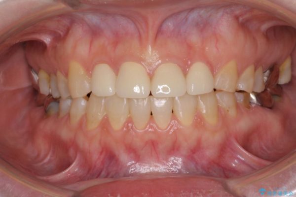隙間の空いた前歯を治したい　部分矯正とオールセラミッククラウン 治療後画像