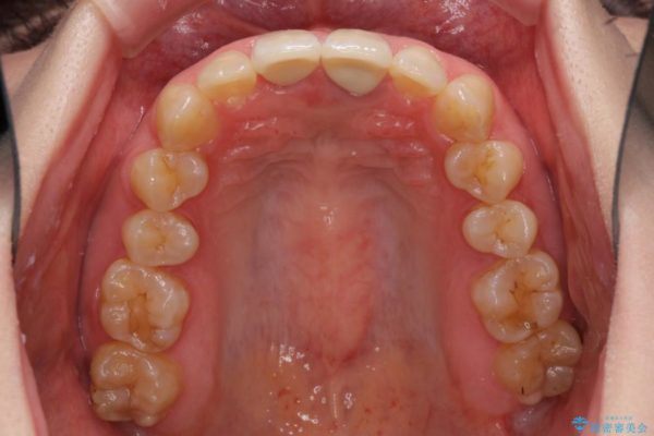 短い前歯を長くしたい 外科処置を用いた前歯のセラミック治療 治療後画像