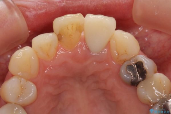 前歯のクラウンの茶色い縁を綺麗にしたい オールセラミックによる治療 治療後画像