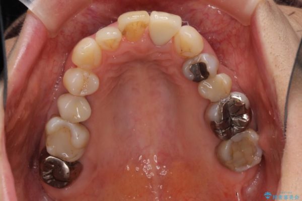 前歯のクラウンの茶色い縁を綺麗にしたい オールセラミックによる治療 治療後画像