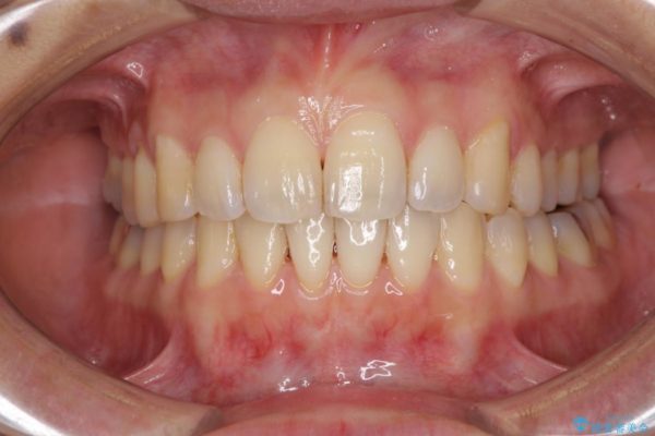 妊娠中でも綺麗な歯並びに インビザラインによる矯正治療 治療後画像
