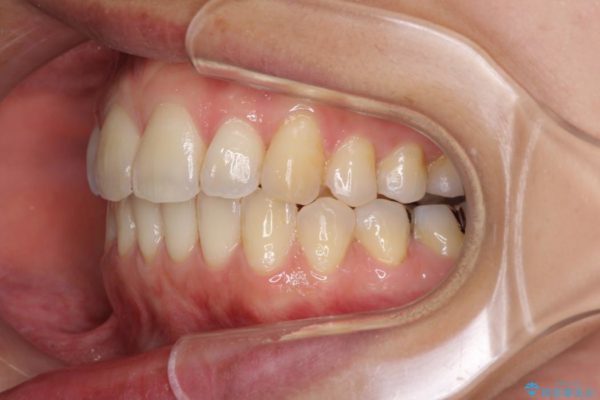 妊娠中でも綺麗な歯並びに インビザラインによる矯正治療 治療後画像