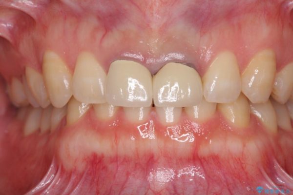 短い前歯を長くしたい 外科処置を用いた前歯のセラミック治療 治療前画像