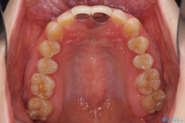 短い前歯を長くしたい 外科処置を用いた前歯のセラミック治療 治療前画像