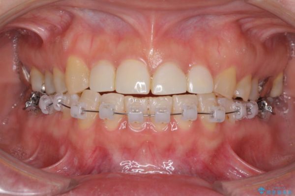 隙間の空いた前歯を治したい　部分矯正とオールセラミッククラウン 治療前画像