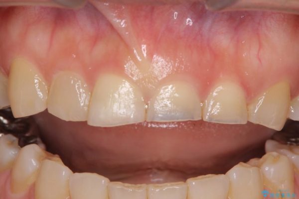隙間の空いた前歯を治したい　部分矯正とオールセラミッククラウン 治療前画像