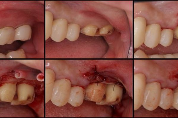 歯肉の奥深くまで進行した虫歯 外科処置による適正な虫歯治療 治療後画像