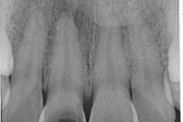 穴が空いて変色した前歯 根管治療とオールセラミッククラウン 治療前画像