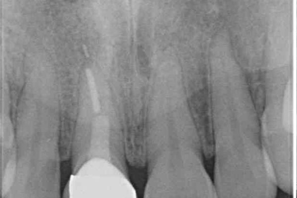 保険診療の前歯が変色してしまった オールセラミッククラウンで自然な前歯に 治療後画像