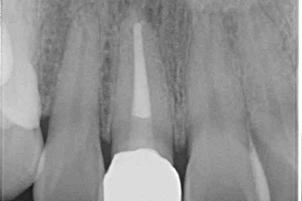 穴が空いて変色した前歯 根管治療とオールセラミッククラウン 治療後画像