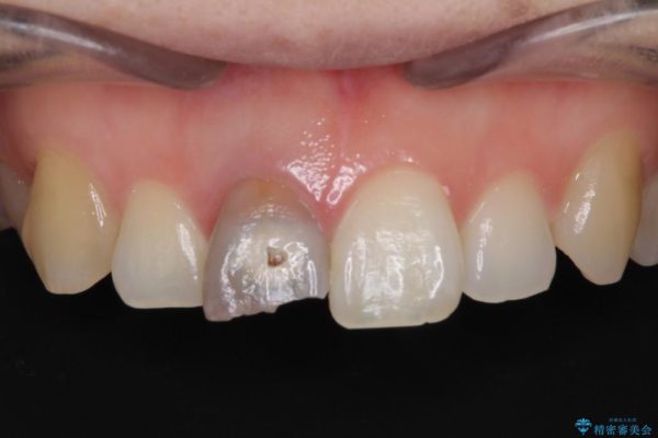穴が空いて変色した前歯 根管治療とオールセラミッククラウン ビフォー