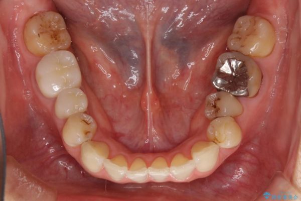 詰め物が取れた 神経の取り除かれた歯のクラウンによる補綴治療 治療後画像