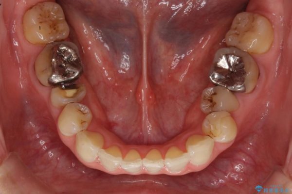 詰め物が取れた 神経の取り除かれた歯のクラウンによる補綴治療 治療前画像