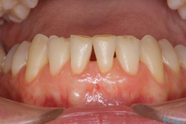 下顎前歯の歯肉退縮 歯肉移植による根面被覆 治療後画像